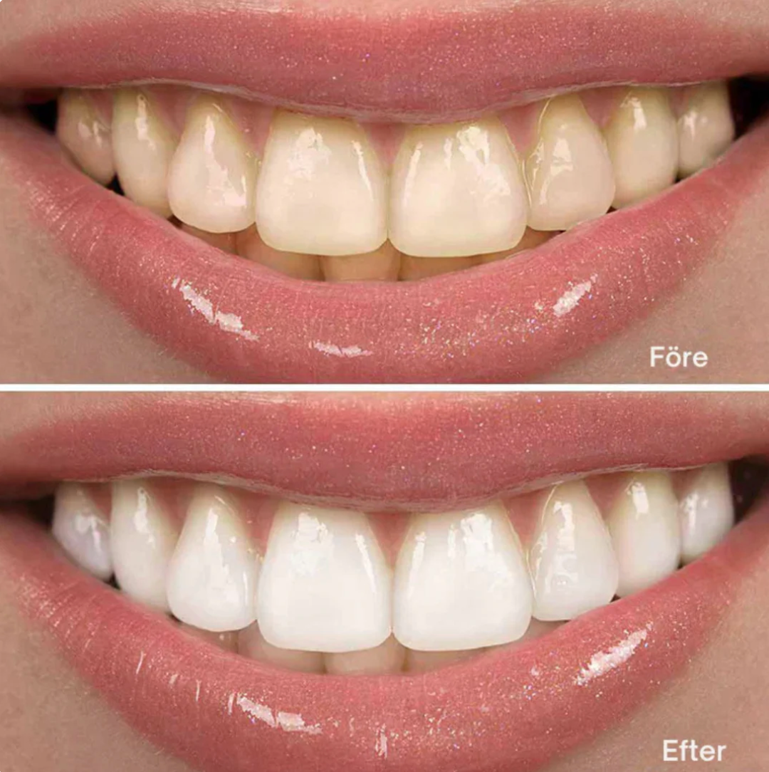 WhiteFast™ – För ett leende du älskar att visa